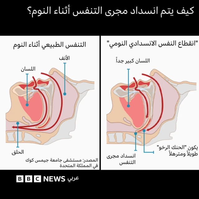 انقطاع التنفس أثناء النوم