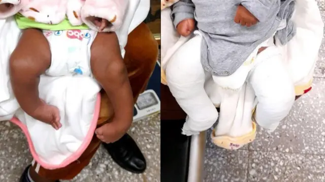 በኢትዮጵያ በየአመቱ አምስት ሺህ የሚጠጉ ህጻናት ከእግር መቆልመም ጋር ይወለዳሉ