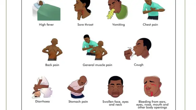 Symptoms of Lassa Fever