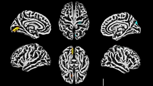 Ressonância magnética mostra alterações na estrutura do córtex cerebral;betfair deposito pixamarelo, a redução na espessura cortical;betfair deposito pixazul, o aumento da espessura