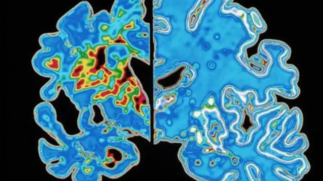 ডিমেনশিয়ায় আক্রান্ত হলে মস্তিষ্কের অনেক টিস্যু নষ্ট হয়ে যায়