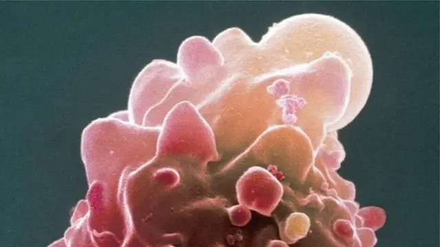 سرطان البروستات