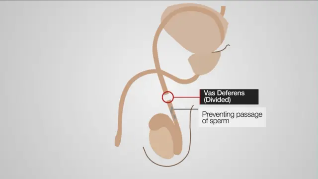 Abaganga bavuga ko amakuru ariho ku byago byava kuri vasectomy ari ayo mu myaka ya 1980