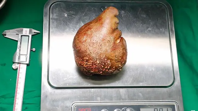 "අපි ඉවත් කරපු ගලේ බර ප්රමාණය ග්රෑම් 800ක්."