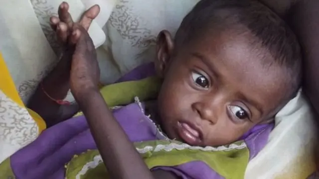 કુપોષિત બાળકો