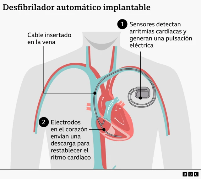 Gráfico ilustra en un dibujo del tórax cómo funciona un desfibriliador automático implantable dentro del cuerpo 