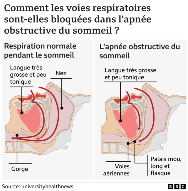 Illustration de l'apnée du sommeil - Comment les voies respiratoires sont-elles bloquées en cas d'apnée obstructive du sommeil ?