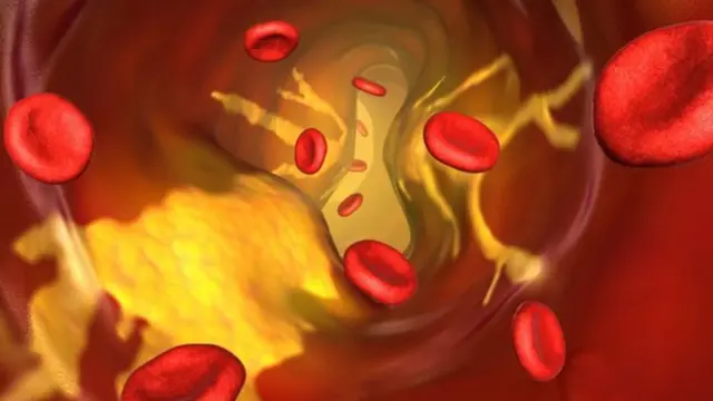 ልዕሊ ዓቐን ሕማቕ ኮለስትሮል ኣብ ሻምብቆታት ደም ይድራዕ