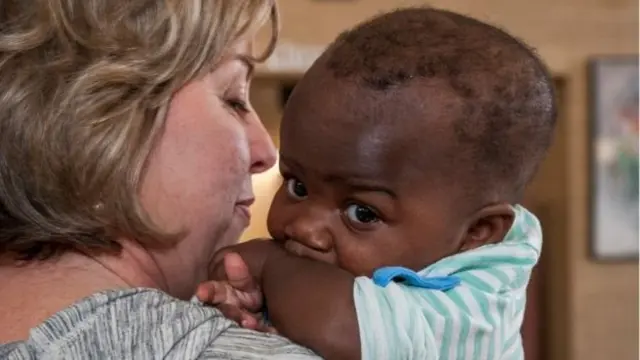 جڑواں بچی، آپریشن