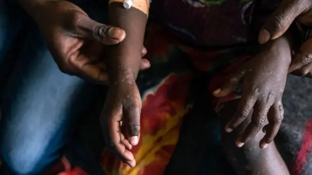 One man show di mpox lesions on one small pikin for Munigi mpox treatment centre for DR Congo.