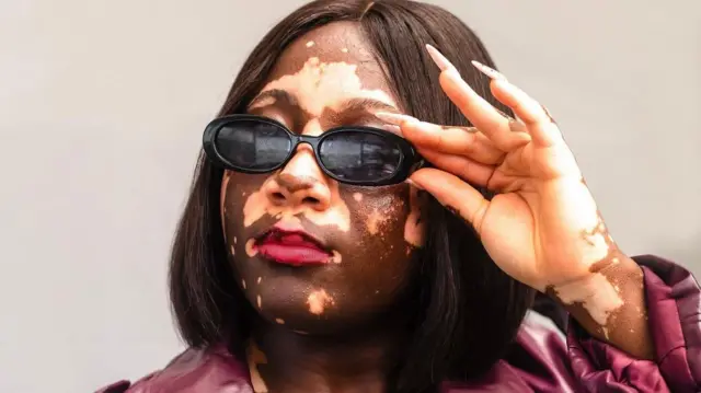 vitiligo is a skin condition that is not contagious