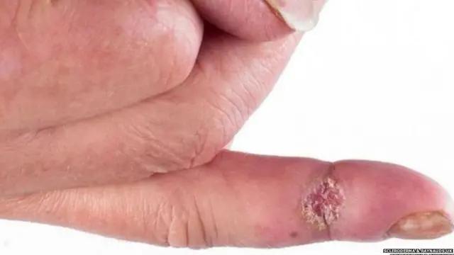 How skin is affected with the scleroderma