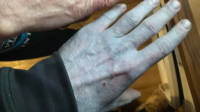 Рука з блакитною шкірою