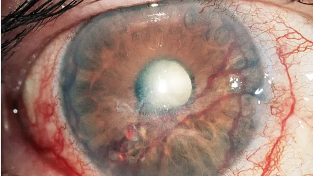 Glaucoma