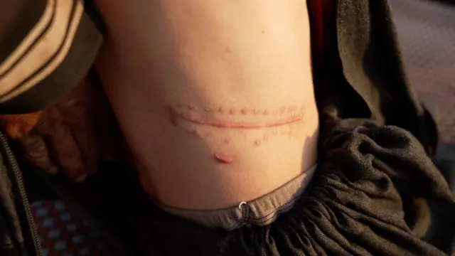 Ammar's scar on his side 