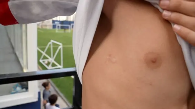 A boy shows a scar caused by a bullet wound on his torso