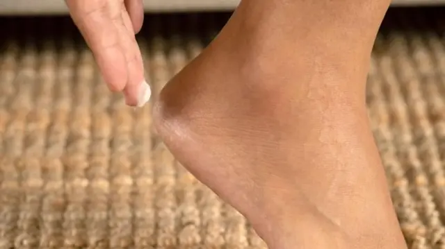 બીબીસી ગુજરાતી પગ એડી ચીરા મહિલા આરોગ્ય સ્કીન