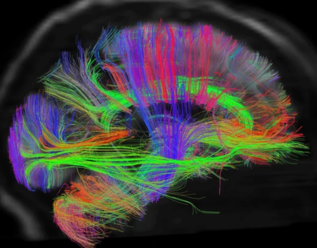 Beynin içindeki elektriksel aktiviteyi gösteren bir röntgen, ışıksal çizgiler her yere dağılmış, birçok renk var.