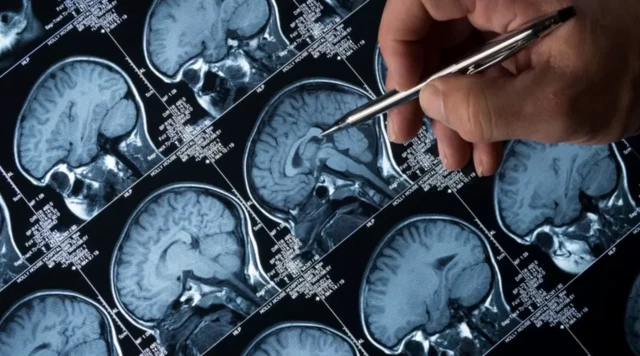 รูปภาพสแกนสมอง 