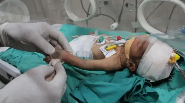 Hospitali ya Kamal Adwan inajaribu kuwatibu watoto wenye utapiamlo na watoto walio na rasilimali chache za kimsingi kama vile maziwa.