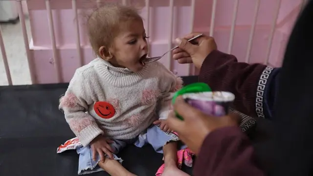 Un niño recibe tratamiento por desnutrición aguda en el hospital Nasser en el sur de Gaza en diciembre de 2025.