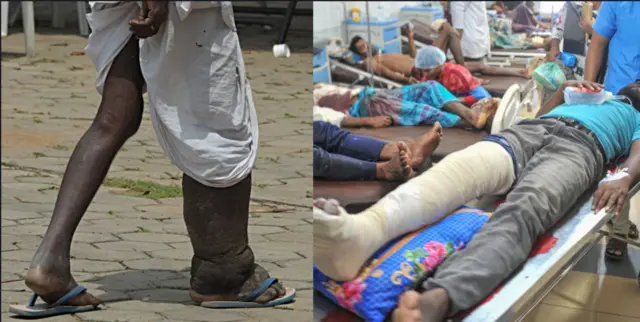 Ọrịa ụkwụ aba shoe' , onye gbajiri ọkpụkpụ