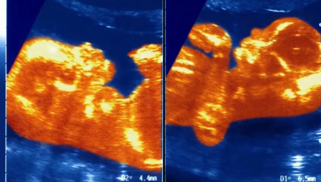 ਐਨਾ ਪੌਲਾ ਦੇ ਕੇਸ ਨੂੰ ਕਾਈਮੇਰਾ ਕਿਹਾ ਜਾਂਦਾ ਹੈ, ਜਦੋਂ ਕਿਸੇ ਵਿਅਕਤੀ ਦੇ ਸਰੀਰ ਵਿੱਚ ਦੋ ਤਰ੍ਹਾਂ ਦੇ ਡੀਐਨਏ ਹੁੰਦੇ ਹਨ