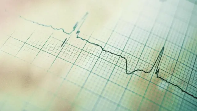 Un electrocardiograma
