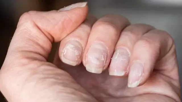 नखं, आरोग्य