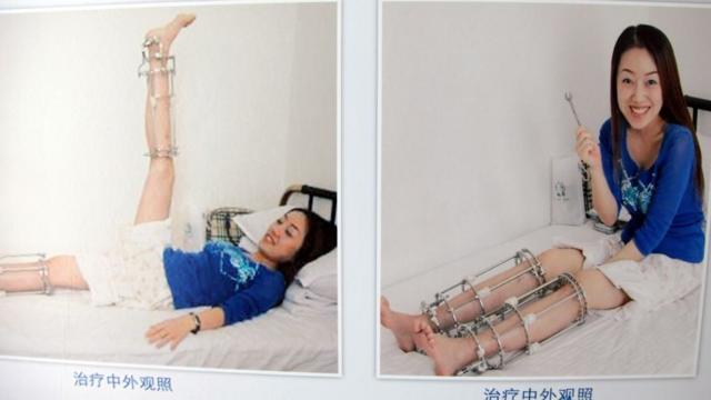 Fotodicas de apostas betfairchinesa após cirurgia