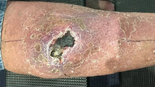 Un ulcère de Buruli à l'arrière de la jambe d'un homme