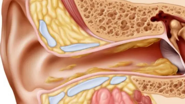 చెవి నాళాల్లోంచి సహజంగా వెలువడే మలినమే గులిమి