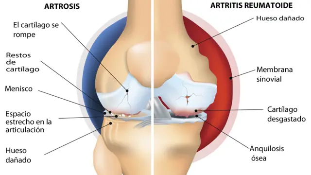 Imagen comparativa entre artrosis y artritis.