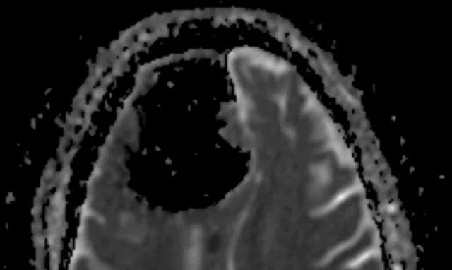 แพทย์ต้องตกตะลึง เมื่อพบโพรงอากาศขนาดใหญ่ในสมองกลีบหน้าด้านขวาของคนไข้