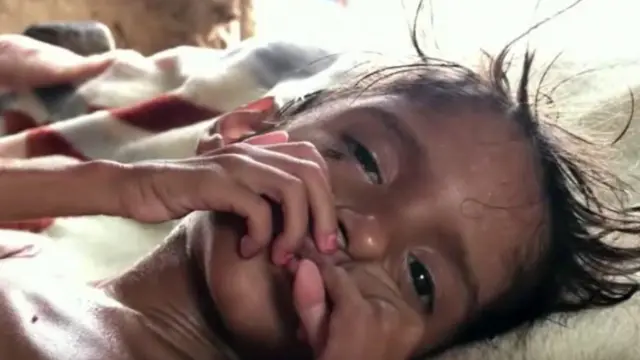 Mzozo wa Yemen umesababisha njaa na utapiamlo miongoni mwa raia wa nchi hiyo wakiwemo watoto