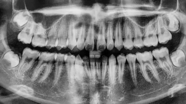 Электрический ток может способствовать восстановлению эмали и лечить кариес