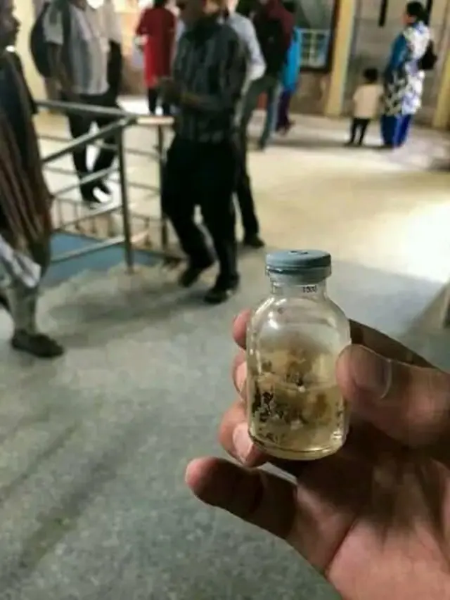 शल्यक्रिया गरेर कुलप्रसाद भट्टराईको शरीरबाट निकालिएका छर्रा