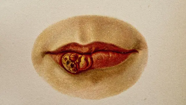 সিফিলিসের উপযুক্ত চিকিৎসা না করালে যৌনাঙ্গ এবং মুখের চারপাশে এধরনের ফোঁড়া দেখা দেয়