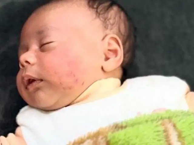 تخشى الأم من أن تترك هذه الندبات تشوها في وجه صغيرها تذكّره بالواقعة طوال العمر