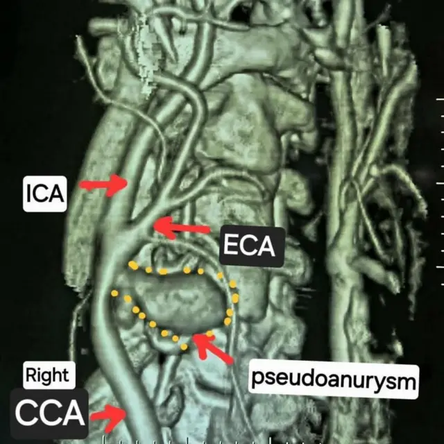 Caption- हे स्कॅन राहुल यांच्या स्थितीची स्पष्ट माहिती देतो, यात त्यांची उजवी कॅरोटिड धमनी, तिचं फाटणं आणि स्यूडोएन्युरिझम दाखवलं आहे.