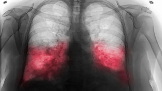 బైలేటరల్ న్యుమోనియా 