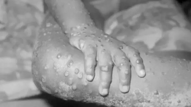 Cacar monyet yang bisa membuat kulit ruam dan melepuh.