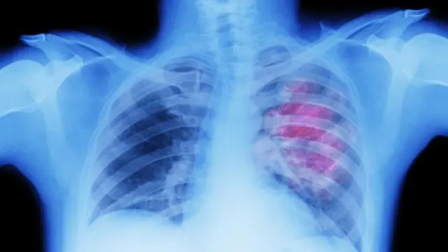 প্রাথমিক অবস্থায় চিকিৎসা করা গেলে ক্যান্সার ছড়িয়ে পড়ার প্রবণতা রোধ করা যায়।