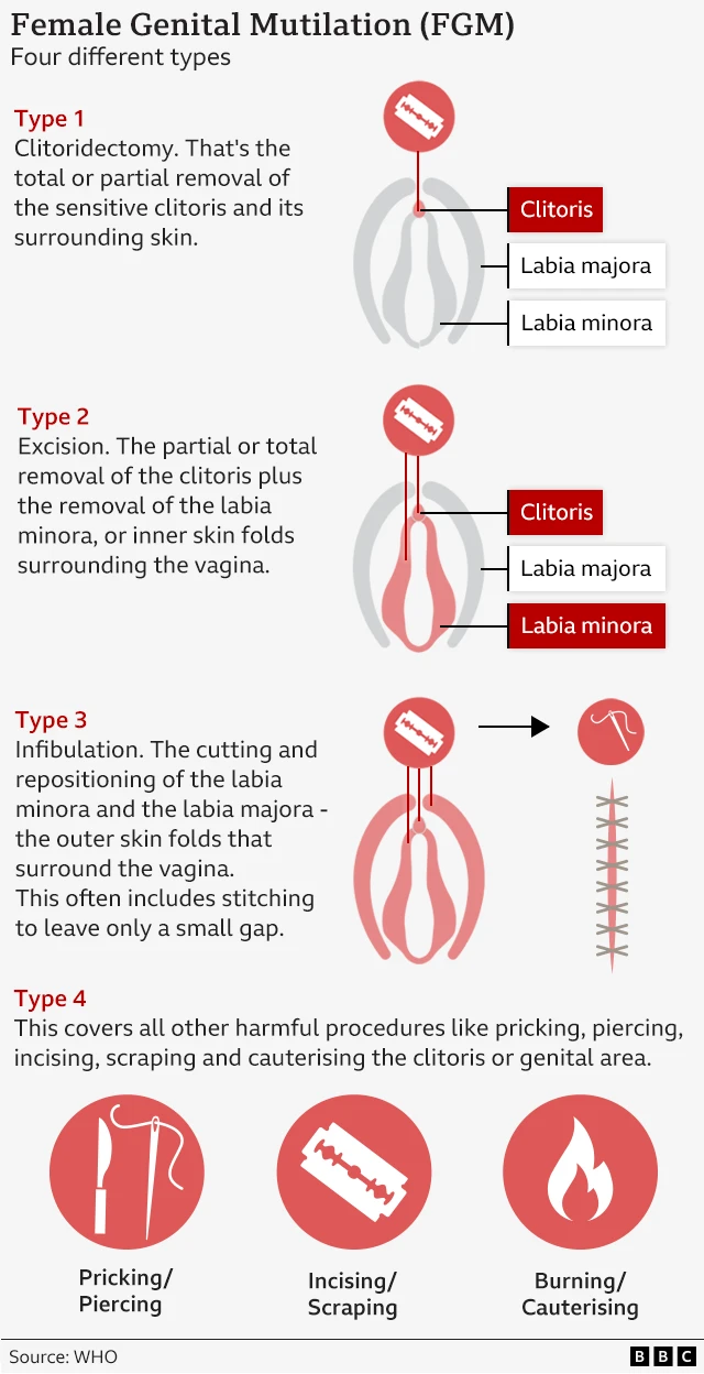 Graphic of the four types of female genital mutilation (FGM) according to the World Health Organization.