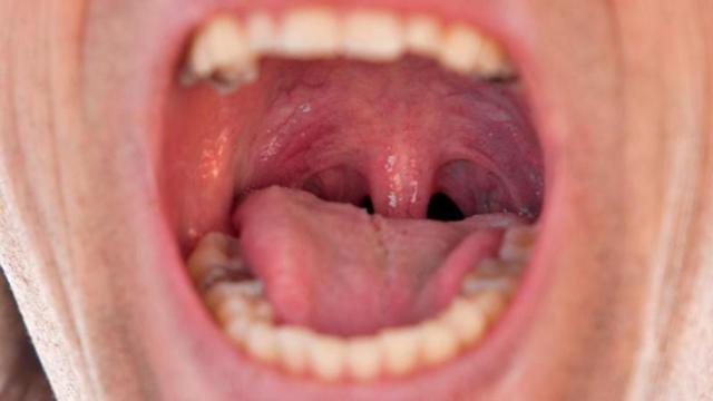 சிறுநீரக கற்கள் முதல் உமிழ்நீர் கற்கள் வரை