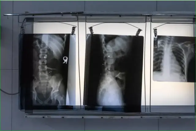 هر دو پسر ترکش گلوله در داخل خود دارند. عمران ترکش بزرگی در ستون فقرات خود دارد