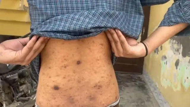 मुकेश और सनी का दावा है कि उन्हें जलती हुई सिगरेट से दागा गया