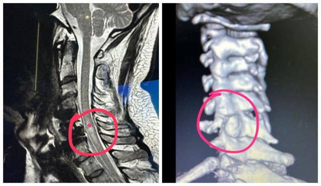 Radiografias mostram lesões na coluna