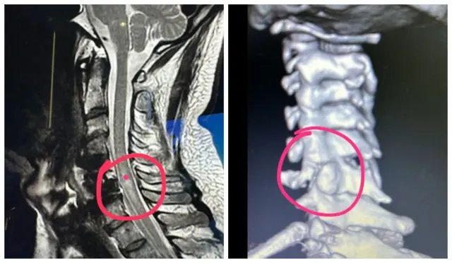 Radiografias mostram lesões na coluna