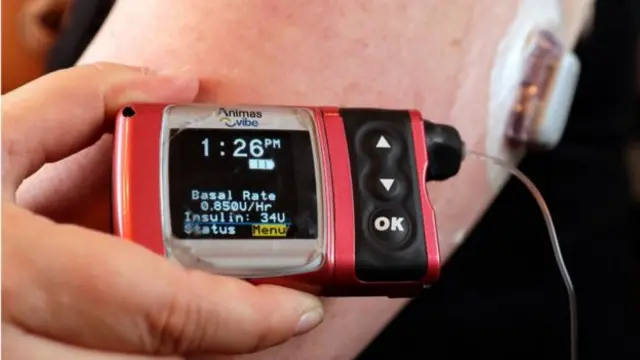 İnsülin pompasının fotoğrafı